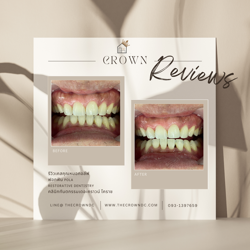 In-office bleaching I ฟอกสีฟัน