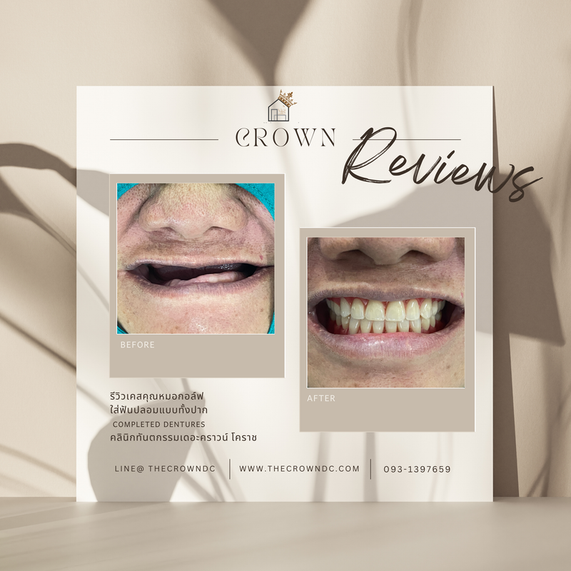 Removable prosthesis | ฟันปลอมถอดได้