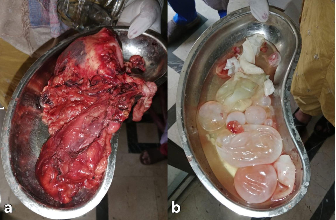 Giant Isolated Splenic Hydatid Cyst with Multiorgan Compression and Pressure-related Atrophy of the Left Hepatic Lobe: A Case Report