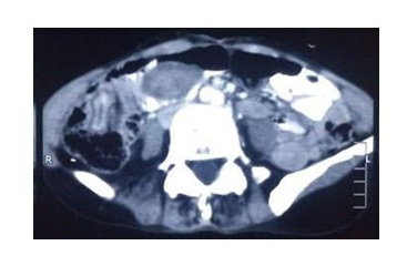 A Rare Presentation of Adult Ileo-ileal Intussusception with Trans-anal Protrusion Secondary to Inflammatory Fibroid Polyp:  A Case Report
