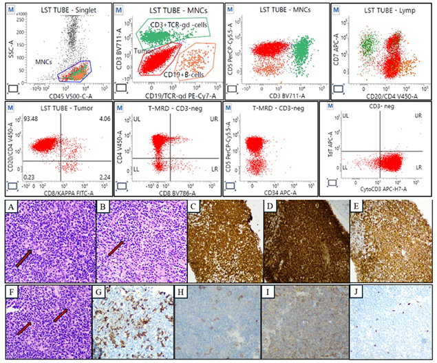 Rare Presentation of Adult T-cell Leukaemia/Lymphoma Mimicking Hodgkin Lymphoma: A Case Report