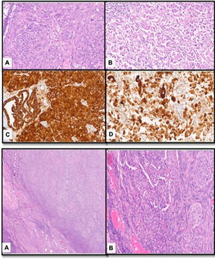 Synchronous Uterine Dedifferentiated Endometrioid Carcinoma and Ovarian Brenner Tumor: An Extremely Unusual Concurrence