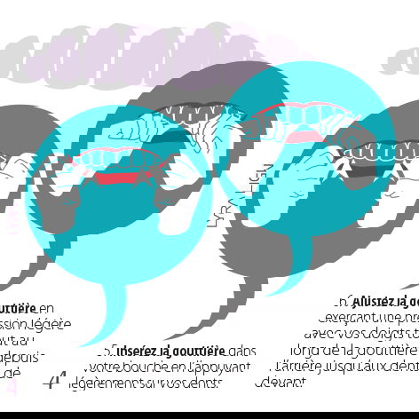 הוראות לשימוש בפלטה לשיניים