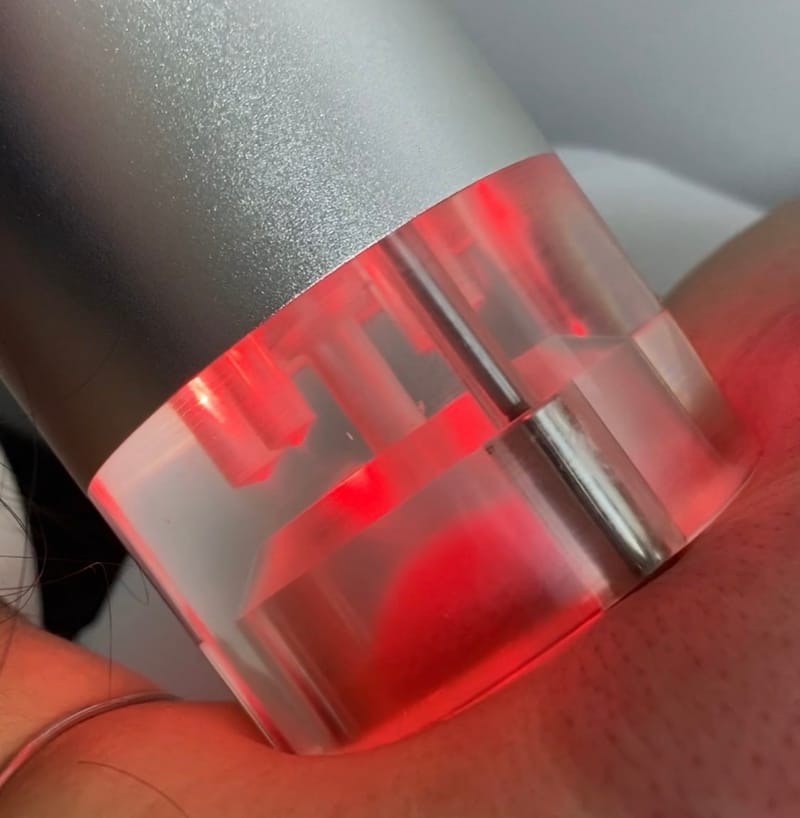 Advanced Cupping And Infrared Therapy in Birmingham | Immediate Pain Relief