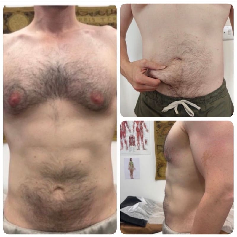 Advanced Body Contouring in Birmingham