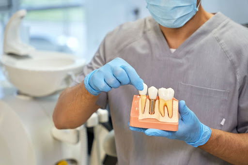 Implants Dentaires en Turquie : Prix, Avantages et Services pour les Francophones