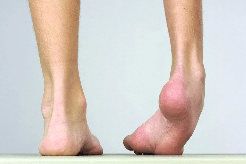 Déformations orthopédiques complexes chez l’enfant : hanche, pied, fémur et inégalité de longueur des jambes