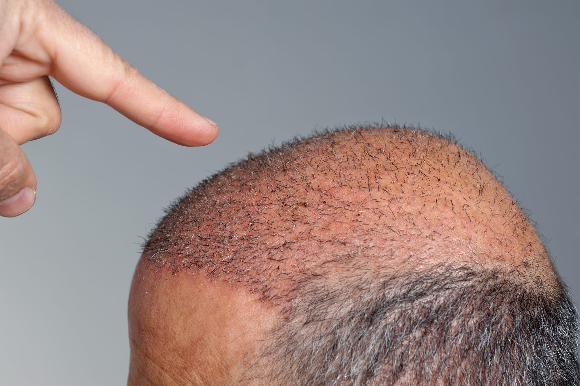 FUE vs DHI : quelle technique de greffe capillaire choisir pour les patients africains ?