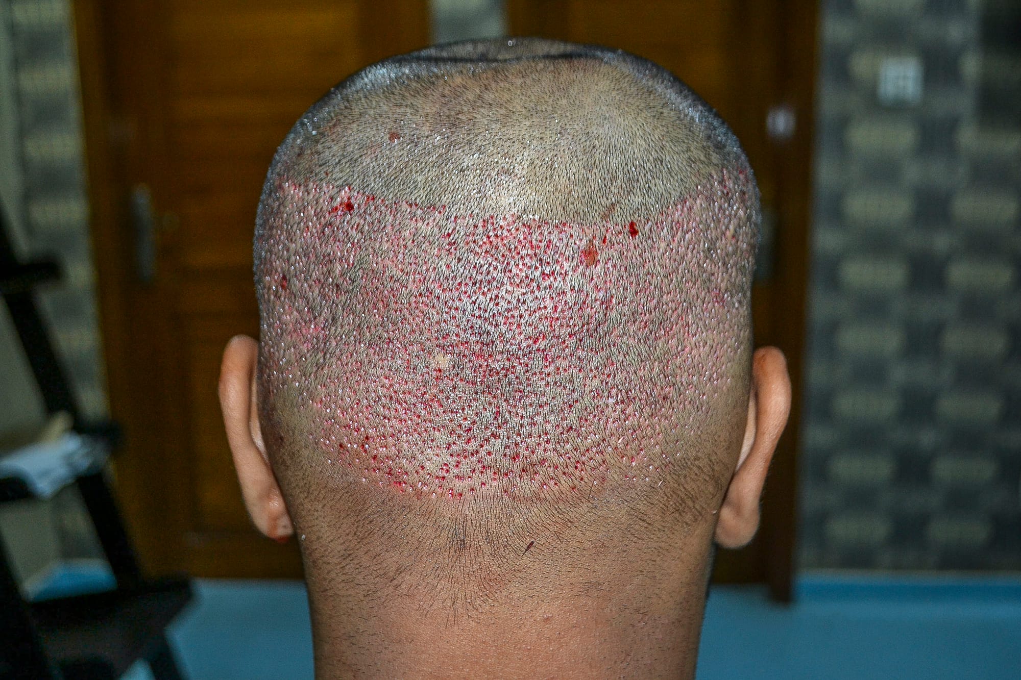 Après une Afro greffe capillaire : les précautions essentielles pour garantir le succès.