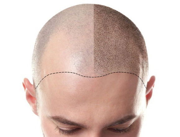 Scalp Micro pigmentation image