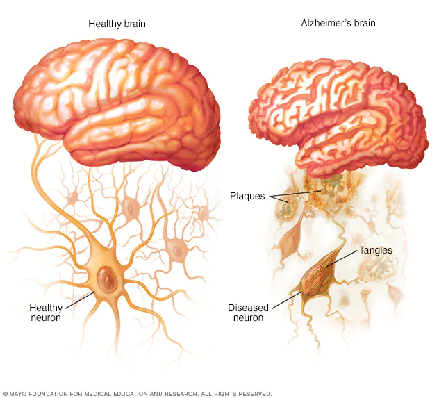 ALZHEIMER AND HOME REMEDIES