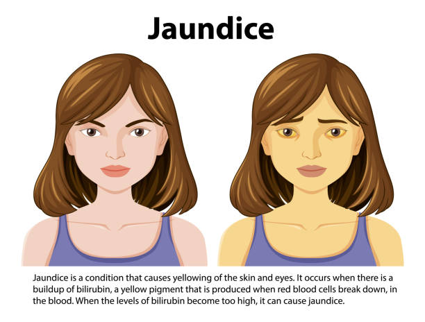 JAUNDICE AND HOME REMEDIES
