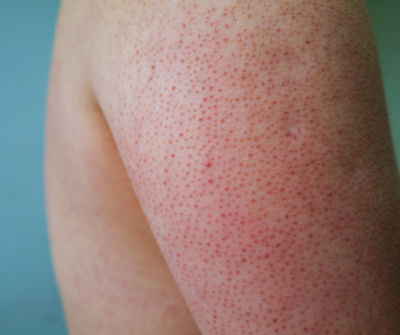 Chicken Skin (Keratosis Pilaris)