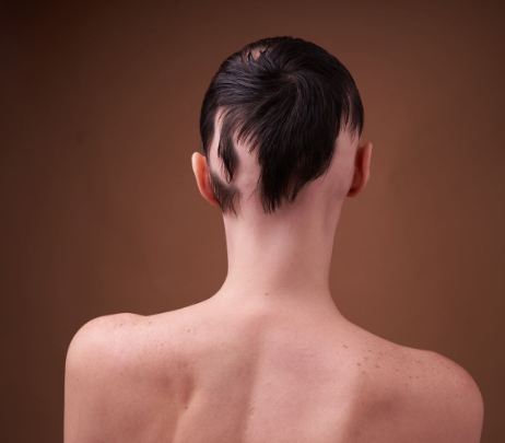 Alopecia (Balding)