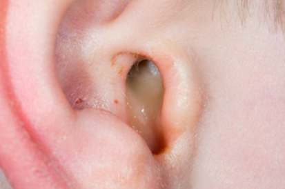 Ear Infection (Otitis Media)