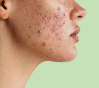 Acne (Pimples)