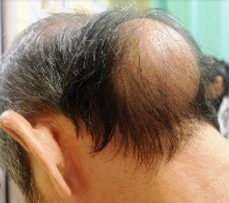 Head Bumps (Lumps on the Scalp)