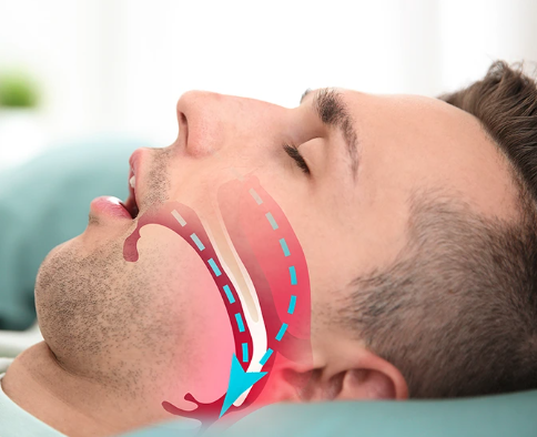 Sleep Apnea