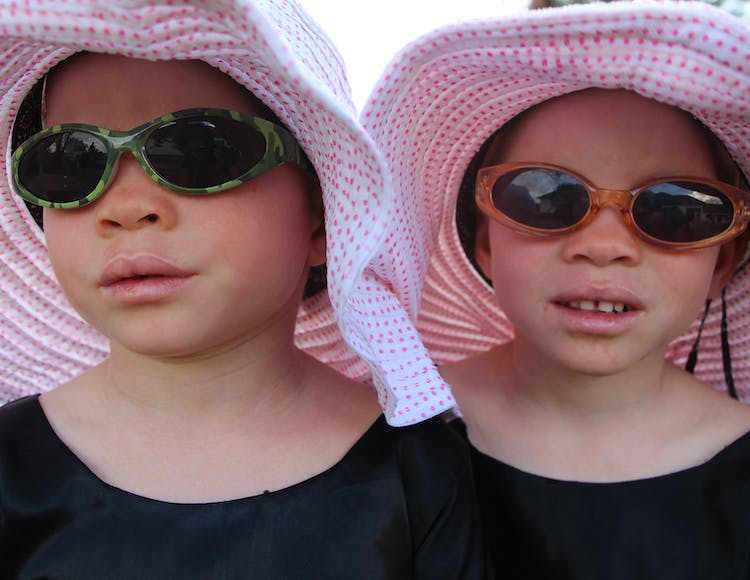 Twins with albinism from Tanzania