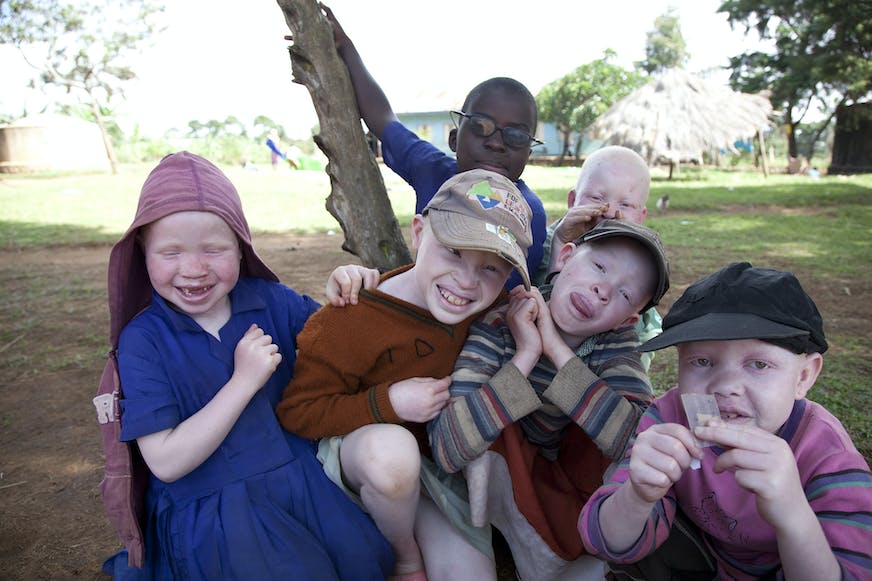 Children with albinism from Tanzania