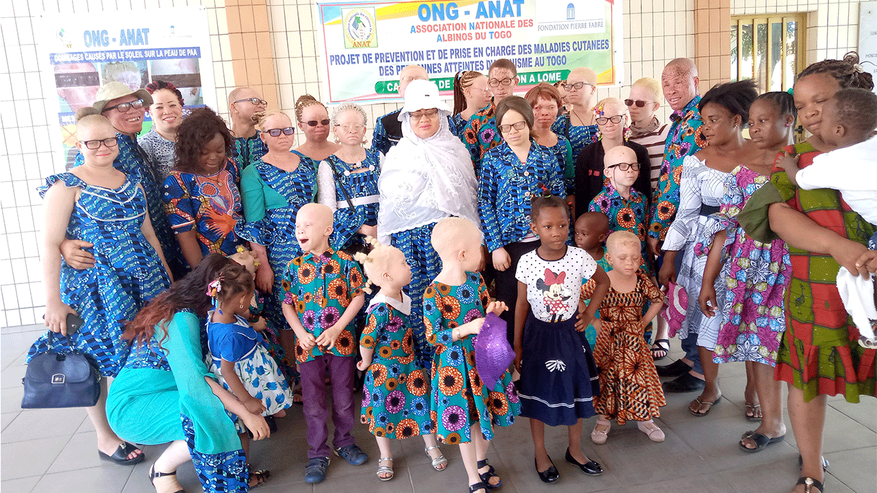 A picture of persons with albinism and others without