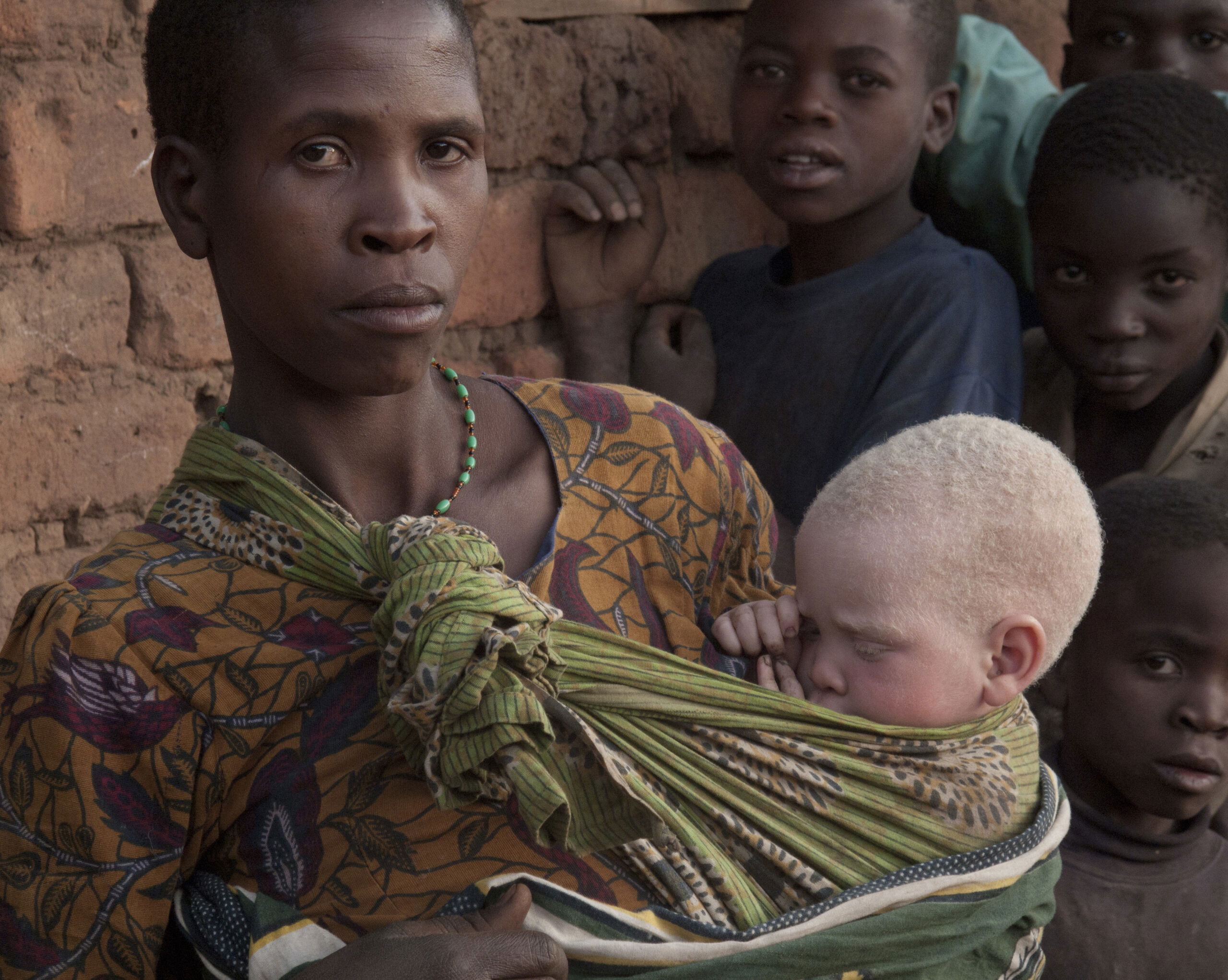 A mother without albinism carrrying a child with albinism