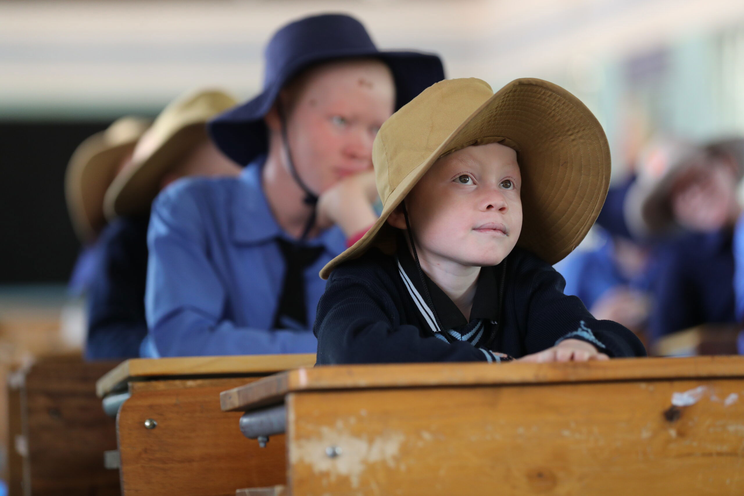 A student with albinism learning in a classroom