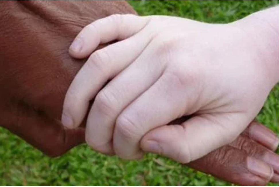 A picture of a hand with albinism and one without