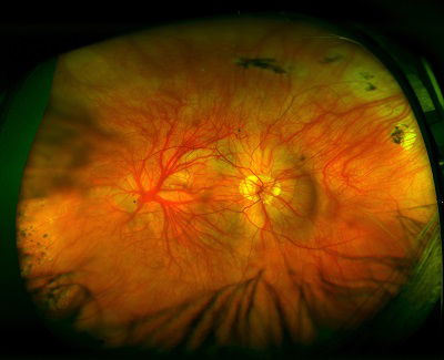 A picture of the retina of the eye of a person with albinism