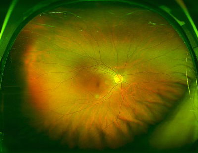 A picture of the retina of the eye without albinism