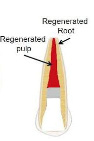 Dental Pulp Regeneration (Revascularization Regenerative Endodontics)
