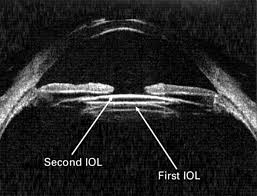 IOL EXCHANGE/PIGGYBACK IOL