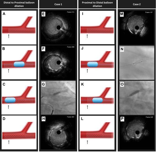 Research Contribution: Novel IVUS Technique Published in JACC: Case Reports