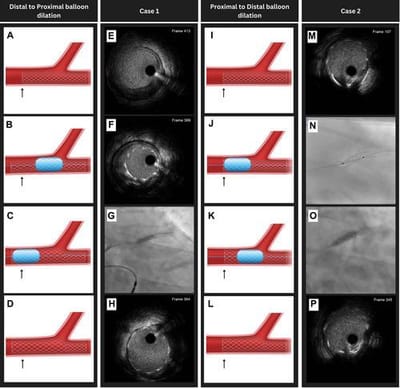 Research Contribution: Novel IVUS Technique Published in JACC: Case Reports