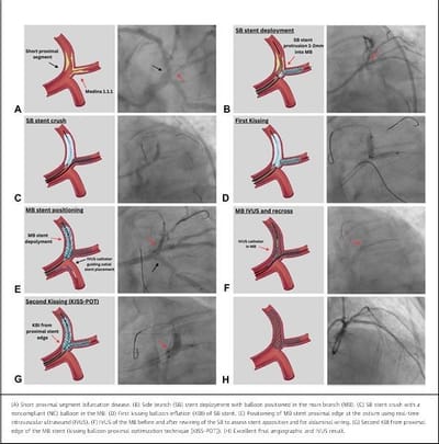 Research Contribution: Publication: KISS-POT Method for Coronary Bifurcation Stenting