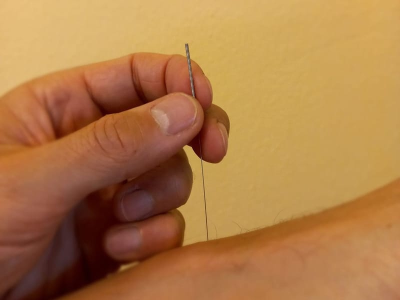 Dry Needling