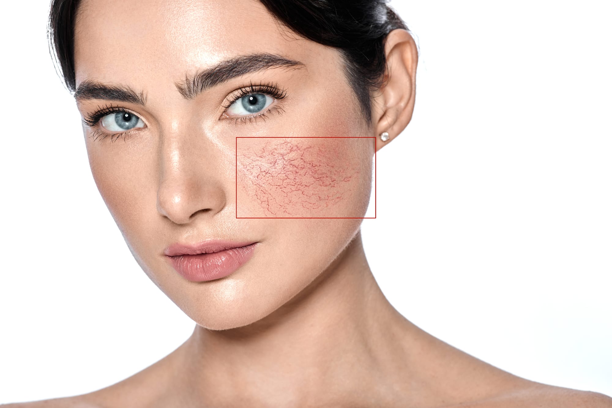 Using Tallow for Rosacea: Reducing Sensitivity Naturally