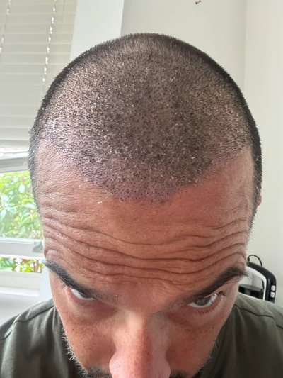 Easy Ways to Maintain GFC Hair Transplant Results in Dubai UAE