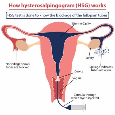 ​Hysterosalpingography (HSG)