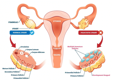 Polycystic Ovarian Disease (PCOD)