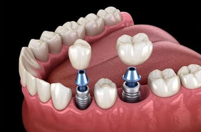 Lors de l’installation d’un implant, A quels genre de problème je serais exposer? - Copier