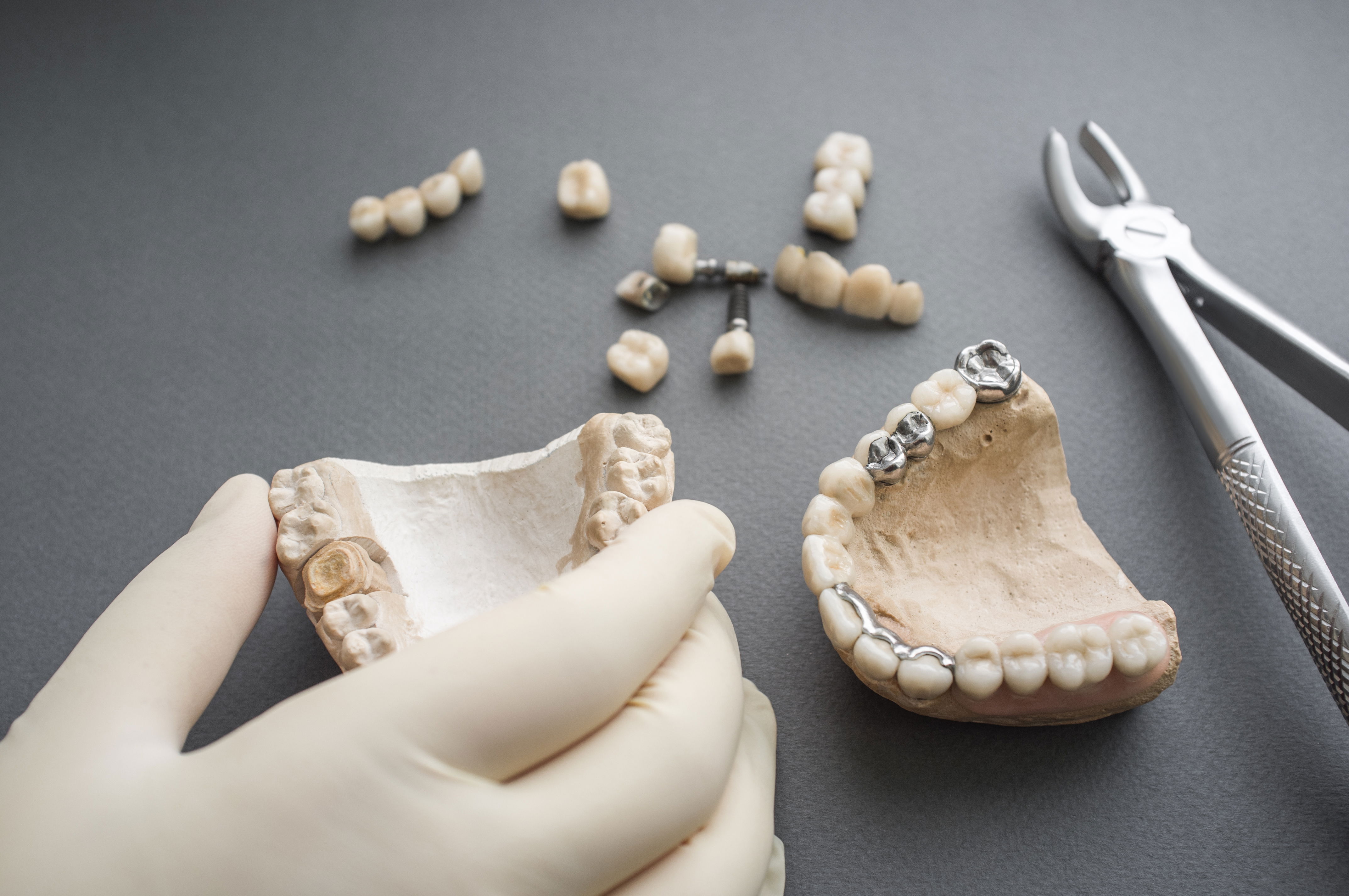 Inlays, onlays et implants dentaires