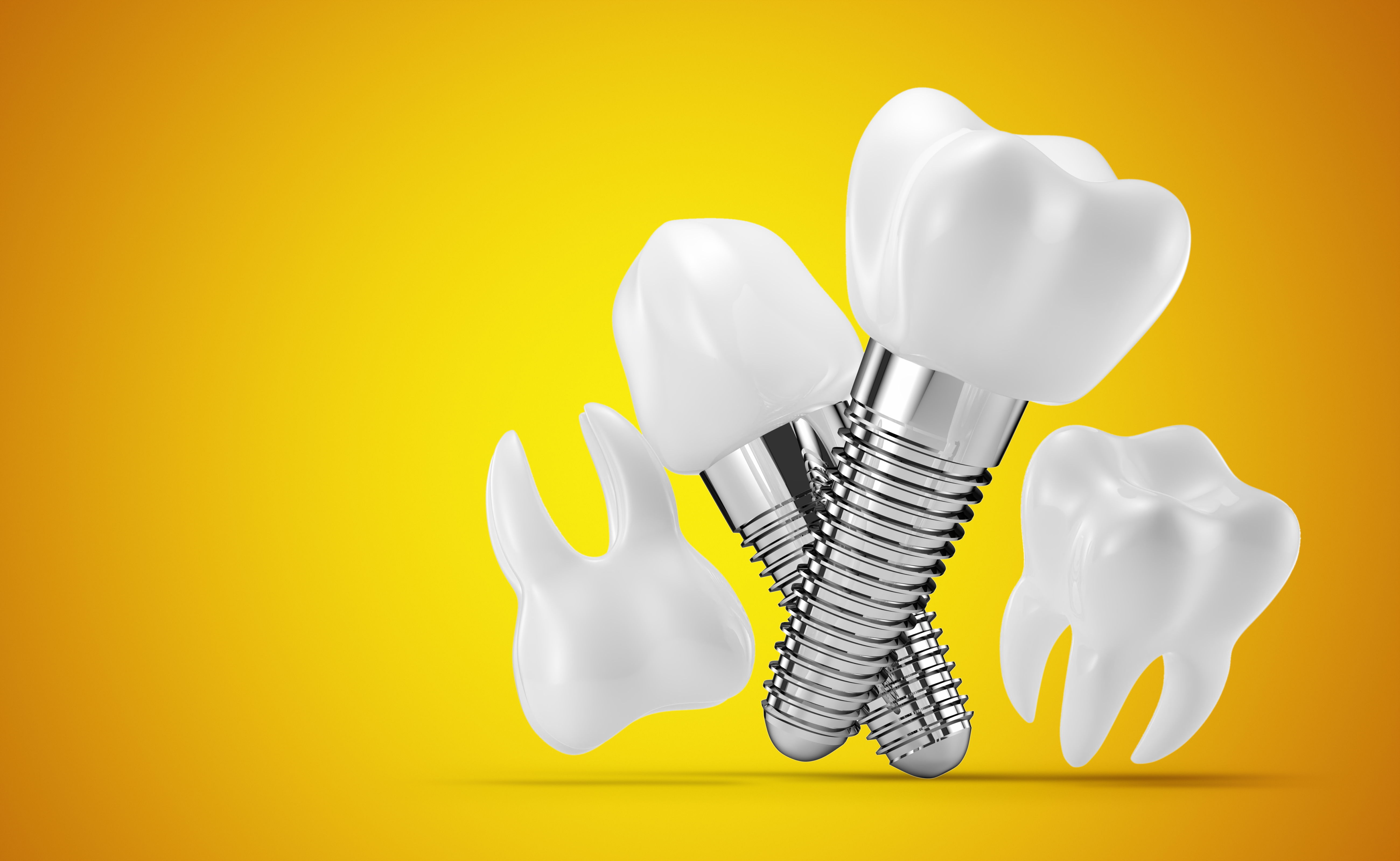  implants dentaires