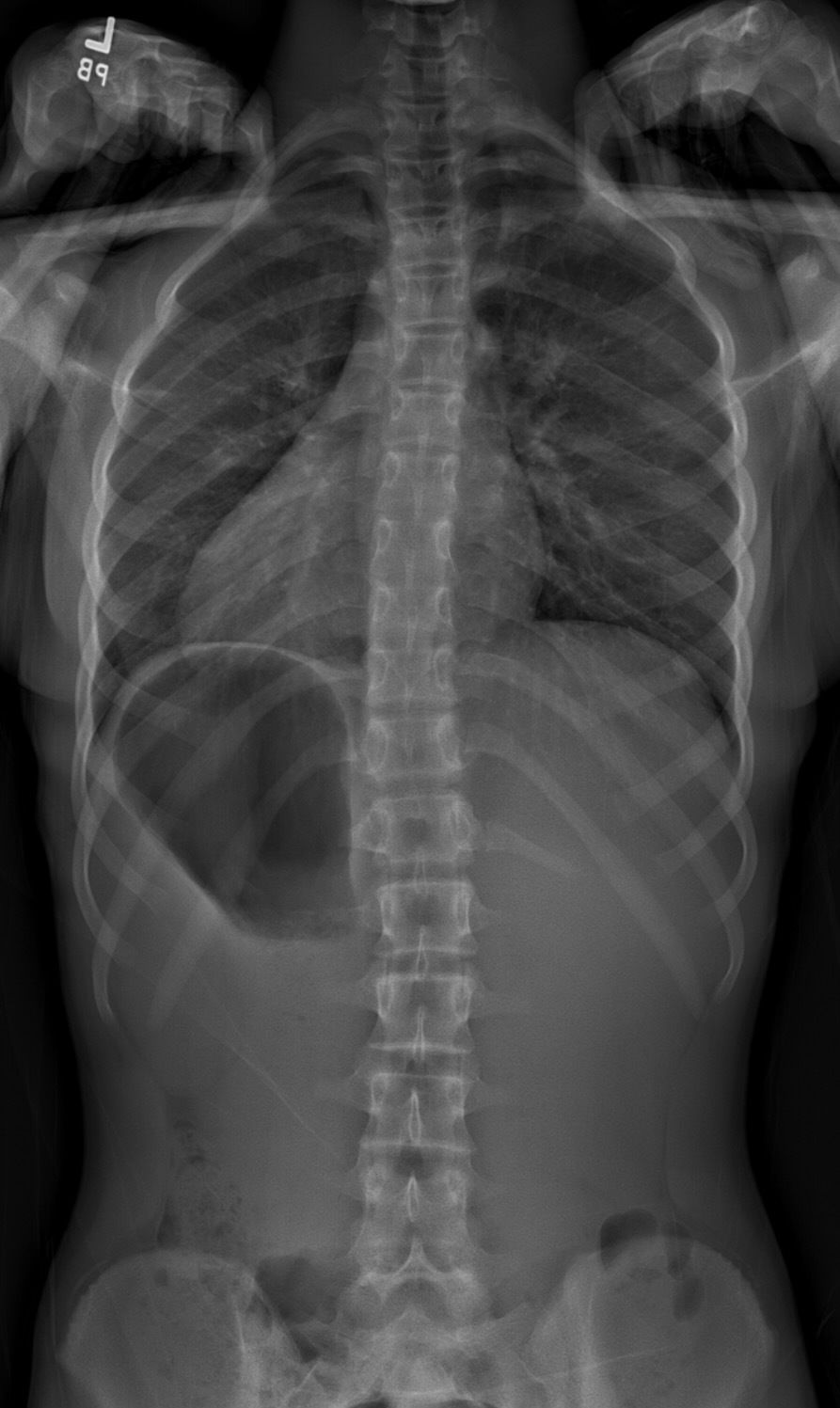 X-rays results of a 12 year old female after 6 months of Schroth and SEAS PT at In Line PT