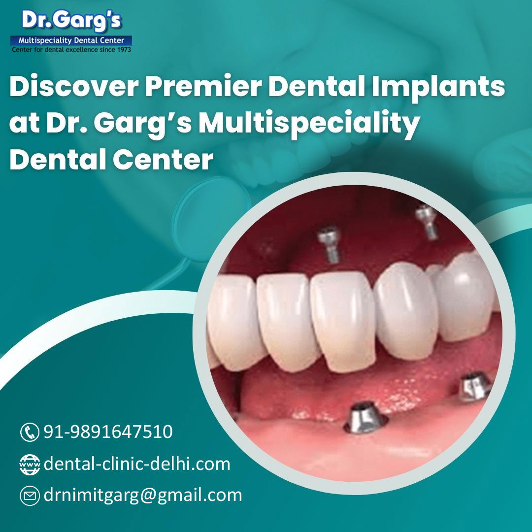 BestDentalImplantsInDelhi