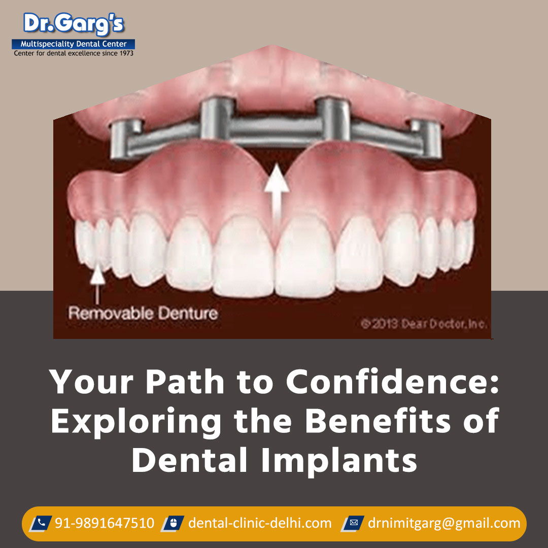 Dr. Garg’s Multispeciality Dental Center for Basal Implants, Zygomatic Implants