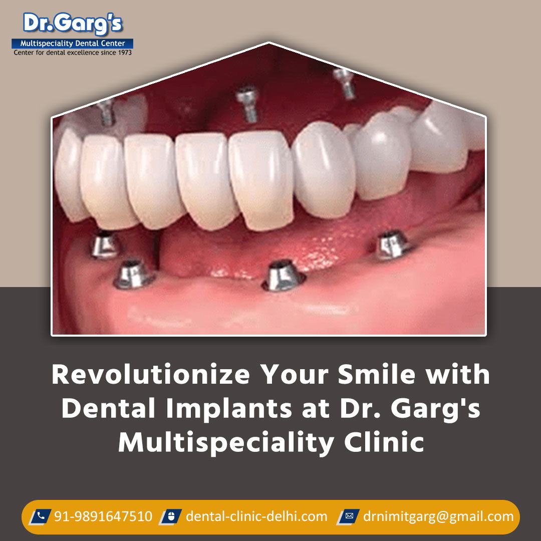 Dental implants