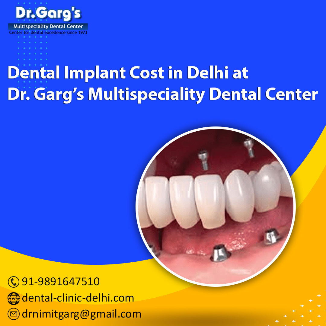 dental implant cost in delhi​