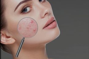 Cold Plasma Behandlung