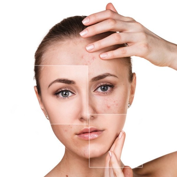 Teenage Facial & Skin Analysis